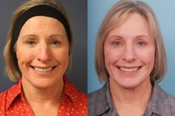 before and after mixto