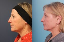 before and after mixto