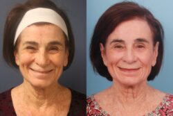 before and after mixto