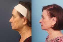 before and after mixto