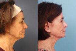 before and after mixto