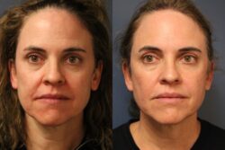 before and after mixto