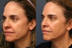 before and after mixto