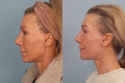 before and after mixto