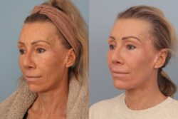 before and after mixto