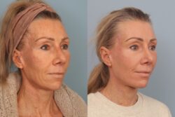 before and after mixto