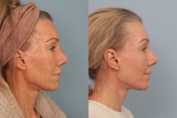 before and after mixto