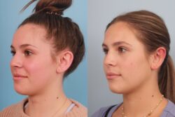 before and after otoplasty
