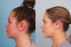 before and after otoplasty