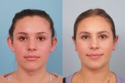 before and after otoplasty