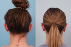 before and after otoplasty