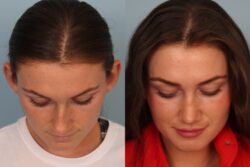 before and after rhinoplasty