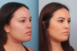 before and after rhinoplasty