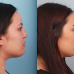 rhinoplasty-merged