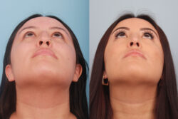 before and after rhinoplasty