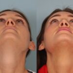 rhinoplasty-merged