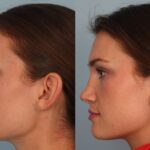 rhinoplasty-merged