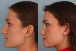 before and after rhinoplasty