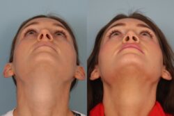 before and after rhinoplasty