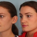 rhinoplasty-merged