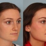 rhinoplasty-merged