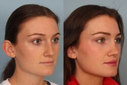 before and after rhinoplasty
