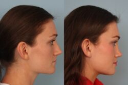 before and after rhinoplasty