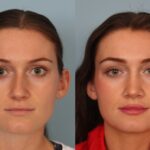 rhinoplasty-merged