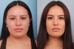 before and after rhinoplasty