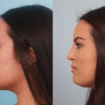 rhinoplasty-merged