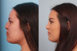 before and after rhinoplasty