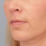 after lip lift 3
