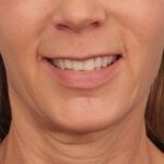 before lip lift 2