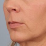 before lip lift 3