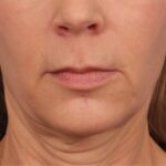 before lip,lift 1