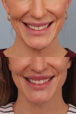 before and after lip lift
