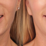 lip-lift-merged (3)