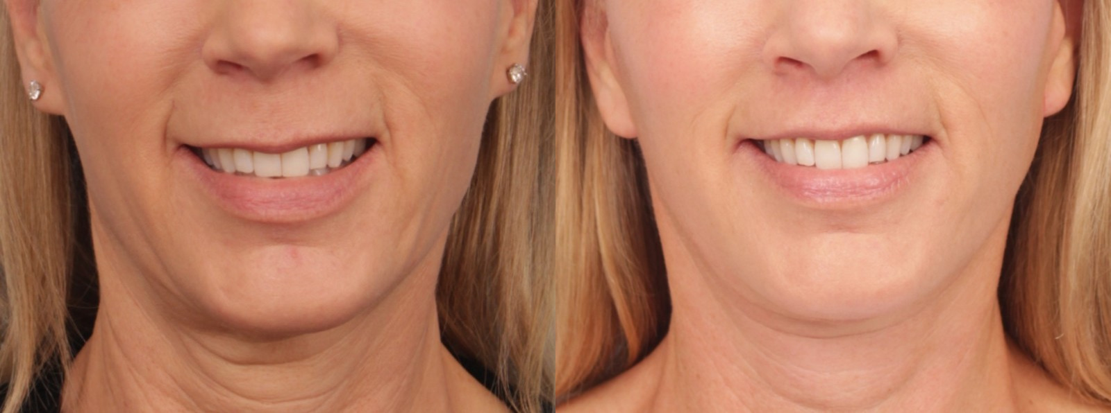before_after_img