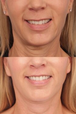 before and after lip lift