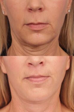 before and after lip lift