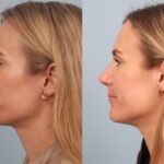 rhinoplasty-merged