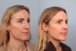 before and after rhinoplasty