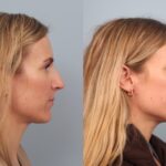 rhinoplasty-merged