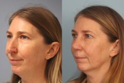 before and after rhinoplasty
