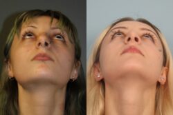 before and after rhinoplasty