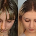 rhinoplasty-merged