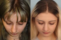 before and after rhinoplasty