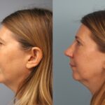 rhinoplasty-merged