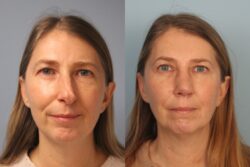 before and after rhinoplasty