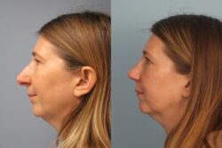 before and after rhinoplasty